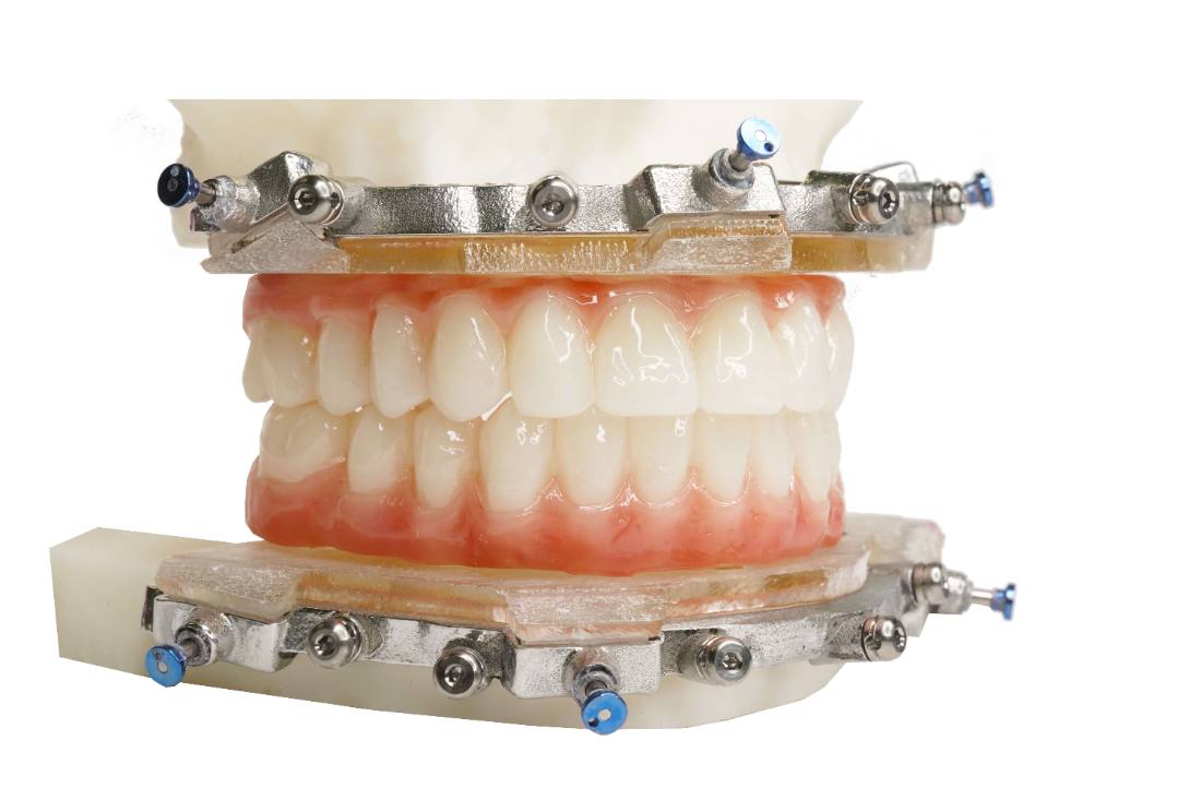 Chrome™ Full Arch Guided Smile — Otella Dental