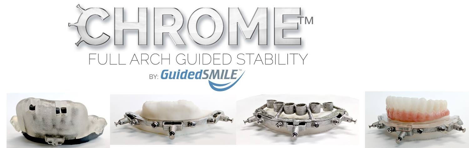 Chrome full-arch guided smile by Otella Dental