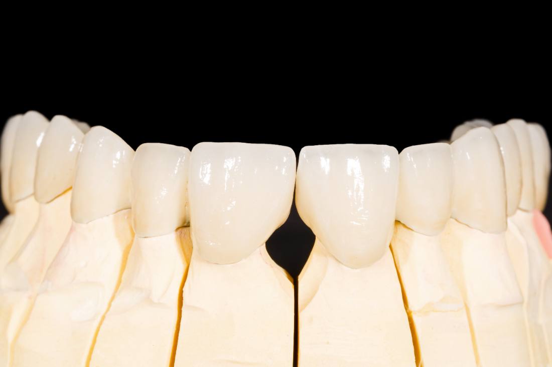 Crown and bridge work by Otella Dental