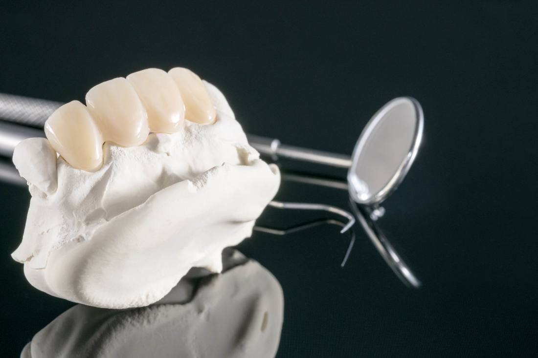 e.max restoration by Otella Dental