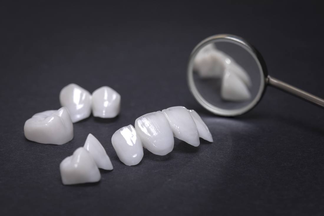 e.max® Crowns & Veneers — Otella Dental