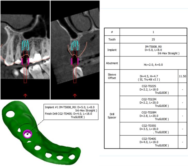 Dental Implant Surgical Guides — Otella Dental