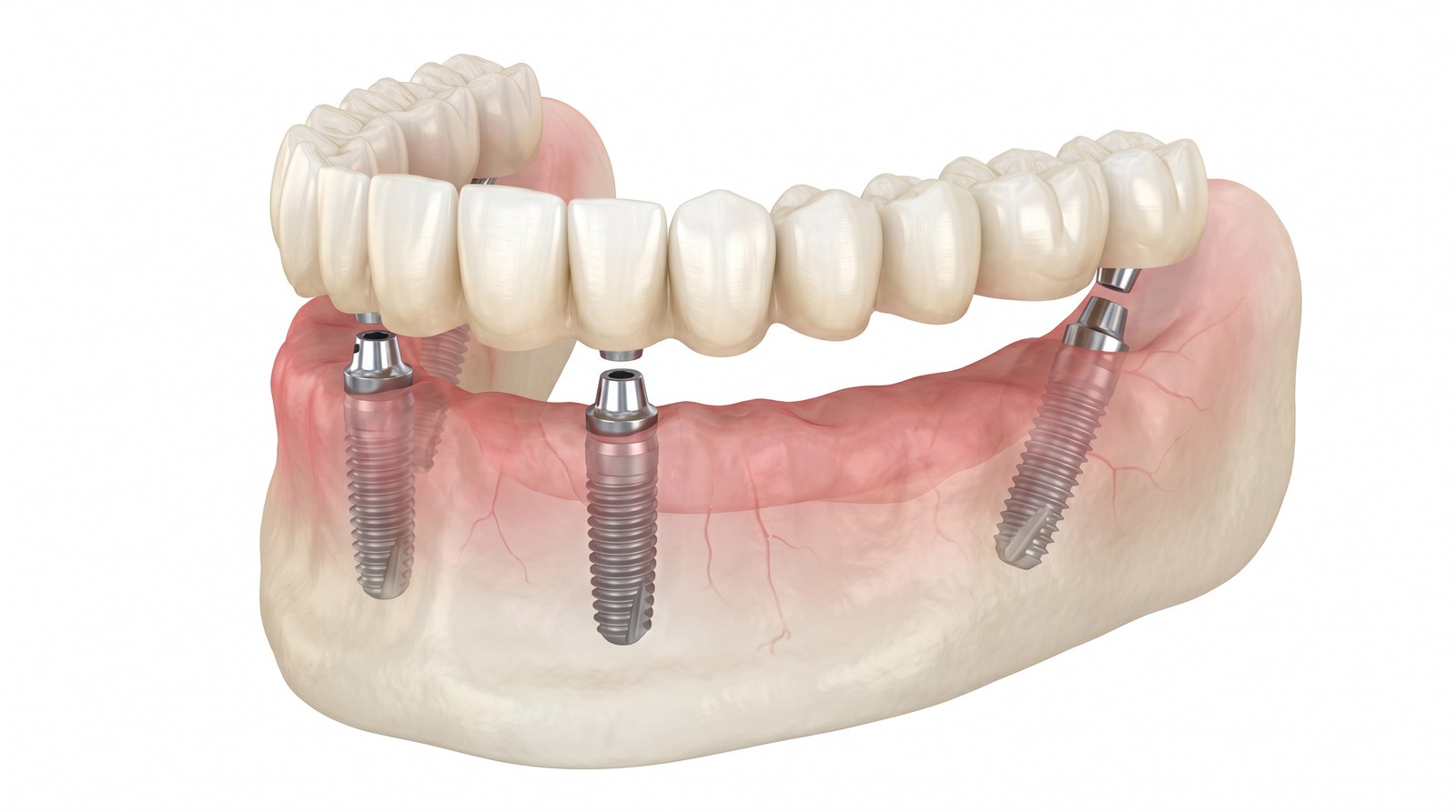 All-on-4 full-arch dental implants by Otella Dental