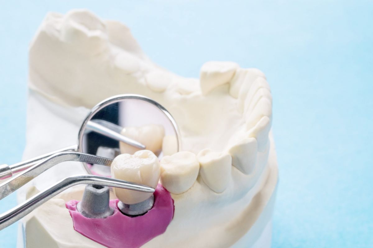 Zirconia Crowns & Bridges — Otella Dental