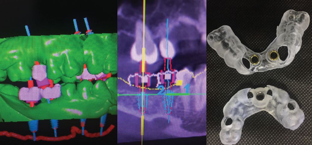 Dental Implant Surgical Guides — Otella Dental