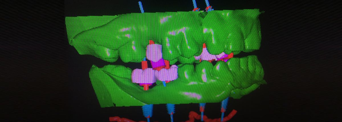 Dental Implant Surgical Guides — Otella Dental
