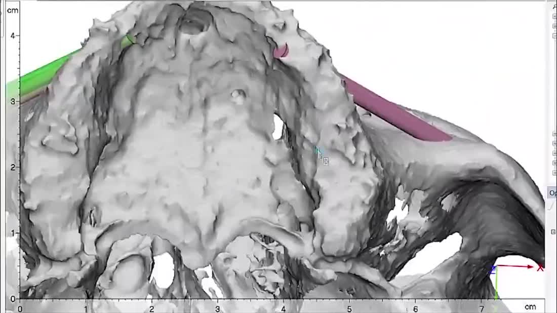 Digital surgical planning — Otella Dental