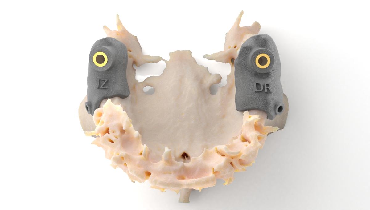 Guides positioned on the maxilla