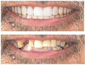 Before and after: Full upper smile rehabilitation