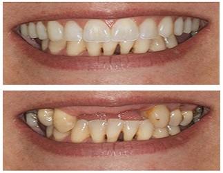 Before and after: Crown & veneer restoration
